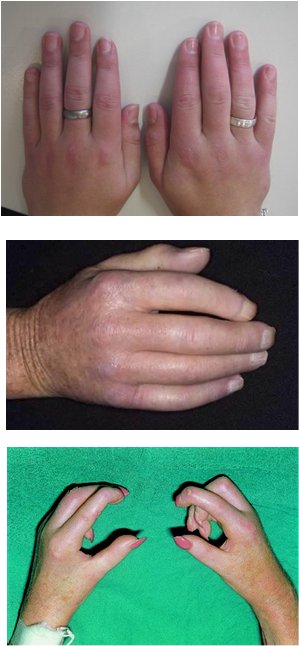 Skliroderma systim4